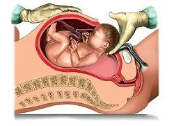 Плановые роды с кесаревым сечением. Показания